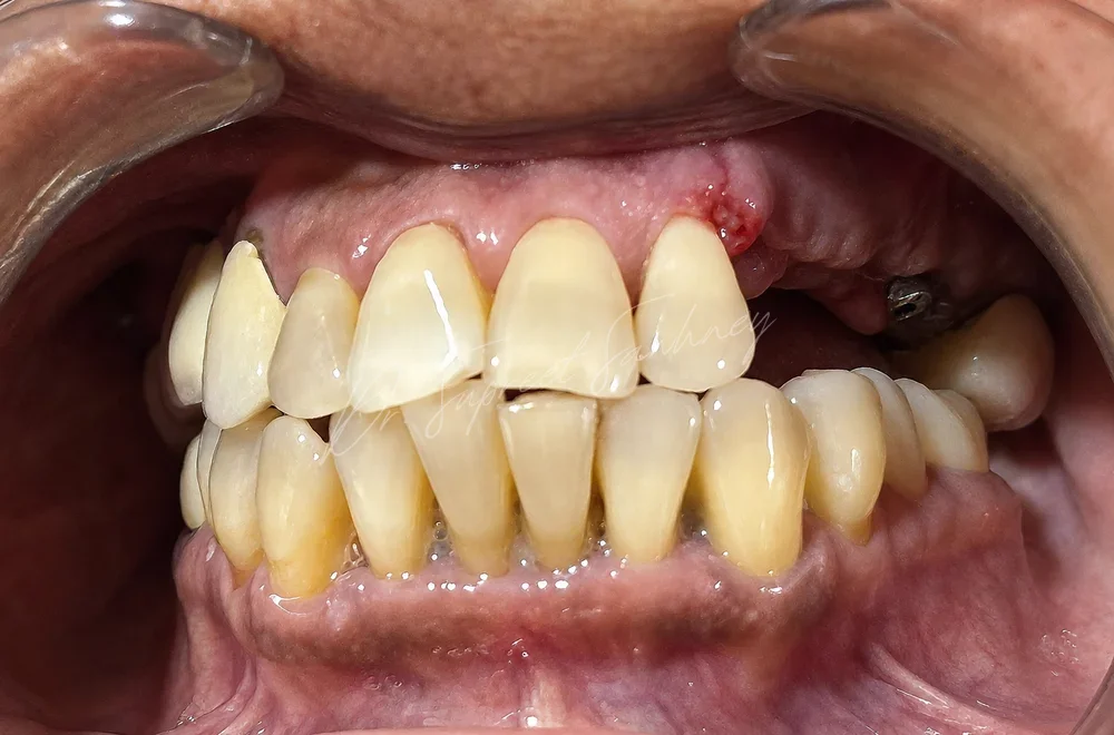 Frontal retracted intraoral photograph showing existing upper restorations and posterior implant sites